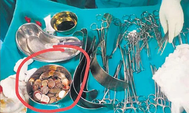 معدے سے 187 سکے نکال لیے